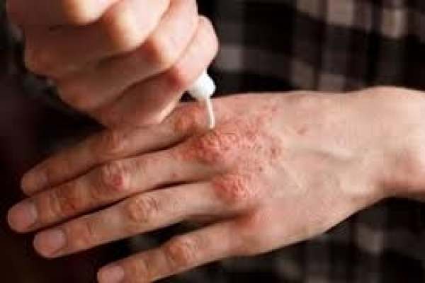 کمبودی-از-بابت-داروی-پسوریازیس-نیست-